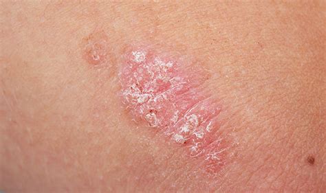 Skin cancer symptoms and signs: Four skin conditions that ...
