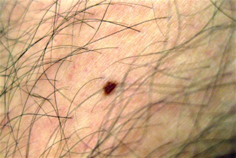 Skin Cancer Symptoms Early Stages | Cancer Signs Treatment