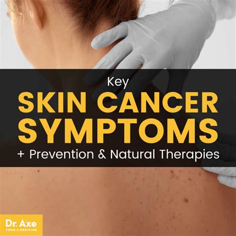Skin Cancer Symptoms, Prevention & Natural Therapies   Dr. Axe