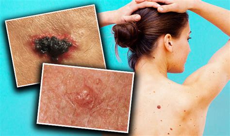 Skin cancer symptoms: Signs of melanoma and non melanoma ...