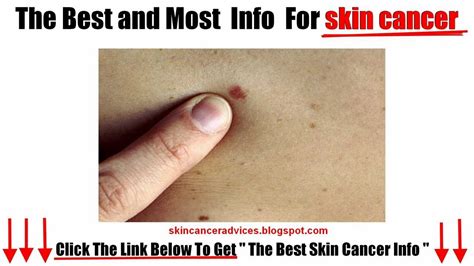 Skin cancer symptoms   YouTube