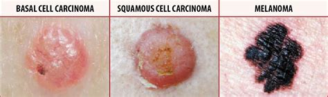 Skin Cancer   Types, Symptoms   Melanoma & Treatment