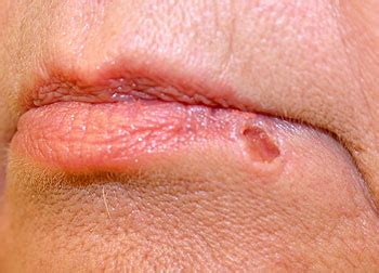 Skin Cancers sign, symptoms & treatment  | MEDICAL CHOICES