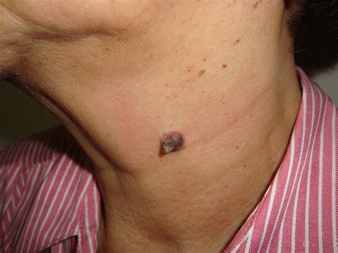 Skin Tumor – Keratoacanthoma on the Neck | ROJoson Medical ...