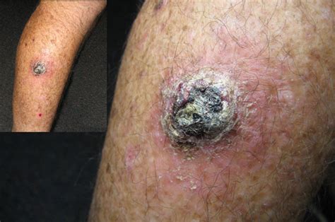 skincancerphysician: Skin cancer: Squamous cell carcinoma