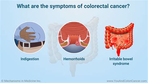 Slide Show   What are the Symptoms of Colon Cancer?