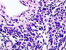 Small cell carcinoma   Wikipedia