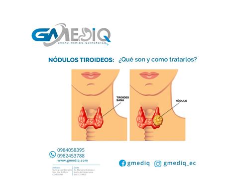 “NÓDULOS TIROIDEOS: ¿QUÉ SON Y COMO TRATARLOS?”   Gmediq   Cirugía ...