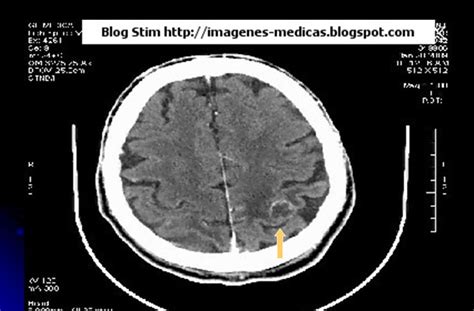 Sobre técnicas de imágenes médicas  Blog STIM : Metástasis ...