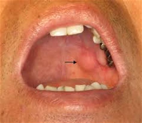 Soft Palate Cancer | Canada| PDF | PPT| Case Reports ...