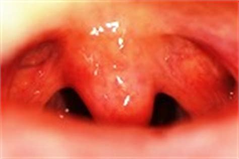 Soft Palate Cancer | Ireland| PDF | PPT| Case Reports ...