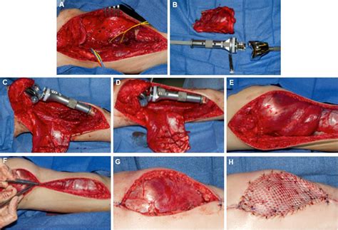 Soft tissue reconstruction after lower extremity limb ...