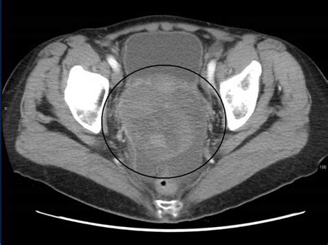 Solid tumour with cystic areas and haemorrhagic fluid?   MCQ