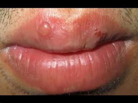 sore on lip not herpes   pictures, photos