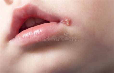 Sore On The Lip Of The Child Herpes Stock Image   Image of ...