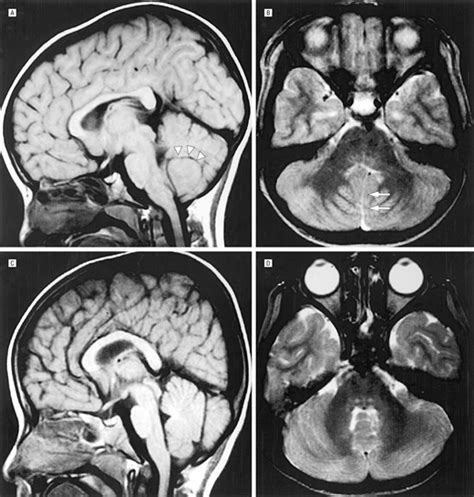 Spasmus Nutans and Congenital Ocular Motor Apraxia With ...