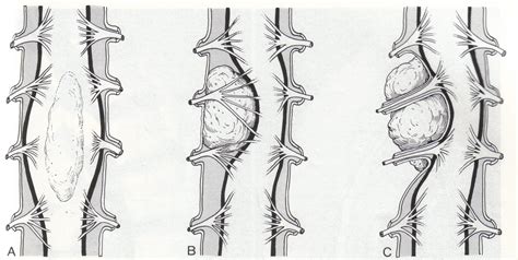 Spinal cord tumor | Spain| PDF | PPT| Case Reports ...