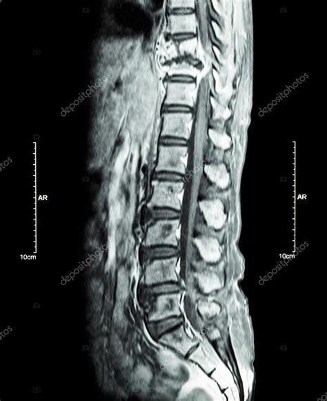Spine metastasis   cancer spread to thoracic spine     MRI ...