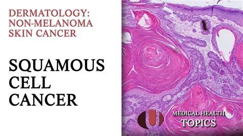 Squamous Cell Cancer [Dermatology] YouTube