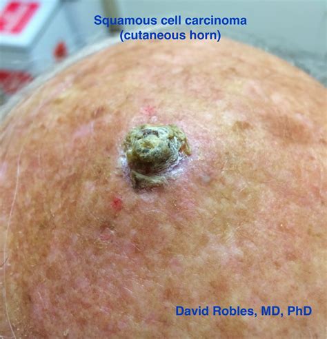 Squamous cell carcinoma is the second most common skin ...