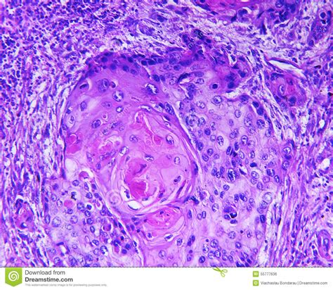 Squamous Cell Carcinoma Of A Human Stock Photo   Image of ...