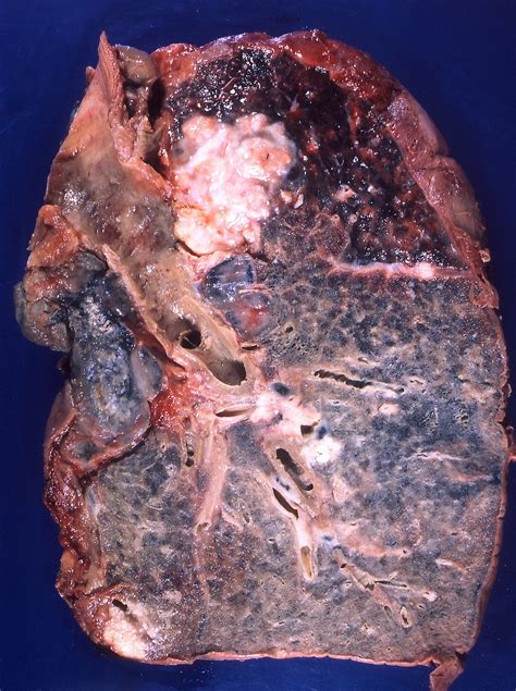 Squamous cell carcinoma of the lung   Wikipedia