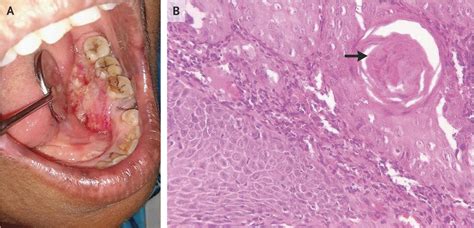 Squamous Cell Carcinoma of the Mouth | NEJM