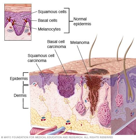 Squamous cell carcinoma of the skin   Symptoms and causes ...