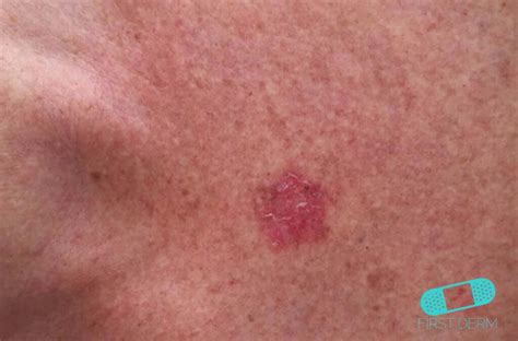 Squamous Cell Carcinoma   Online Dermatology