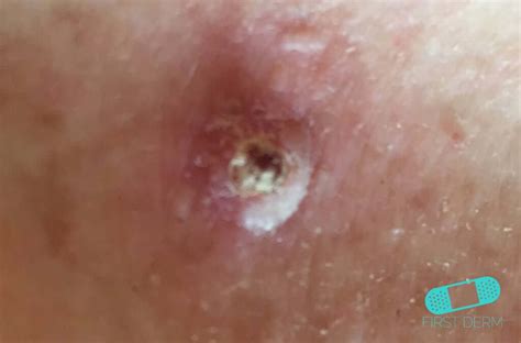 Squamous Cell Carcinoma   Online Dermatology