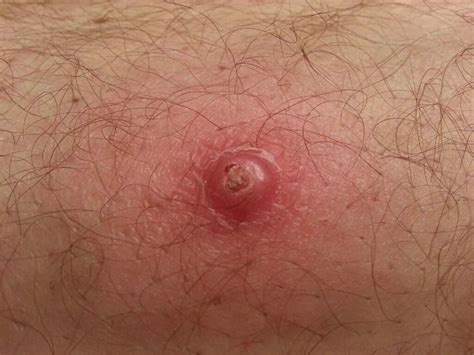 Squamous cell carcinoma  SCC    pictures   cancer photos ...