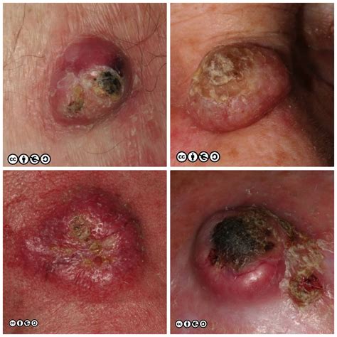 Squamous cell carcinoma Skin Cancer 909