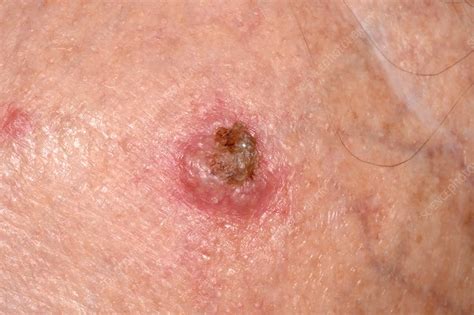 Squamous cell carcinoma skin cancer   Stock Image   C037 ...