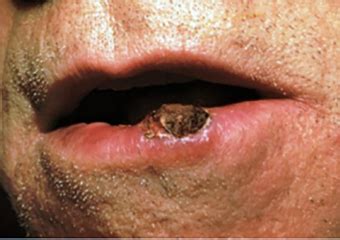 Squamous Cell Carcinoma Warning Signs and Images The ...