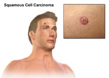 Squamous cell skin cancer   Wikipedia