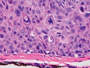 Squamous cell skin cancer   Wikipedia