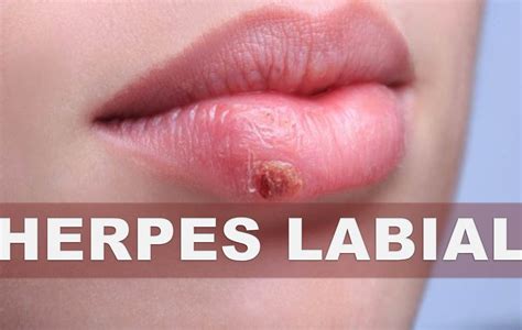 ☞Remedios caseros para el herpes labial –Eliminar las ...