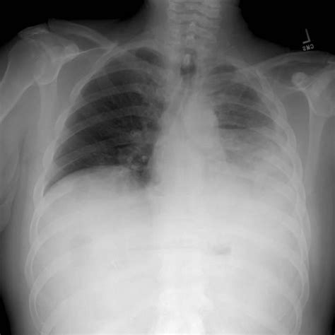 胸水   07. 肺と気道の病気   MSDマニュアル家庭版
