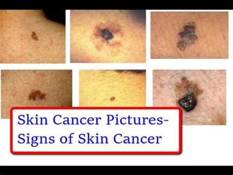 ☞Skin Cancer Pictures   Signs of Skin Cancer in Pictures ...