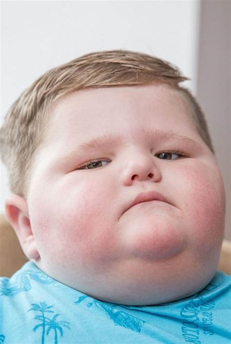 Гипоталамическое ожирение: 40 кг в 3 года