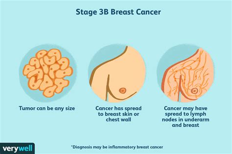 Stage 3 Breast Cancer: Types, Treatment, Survival