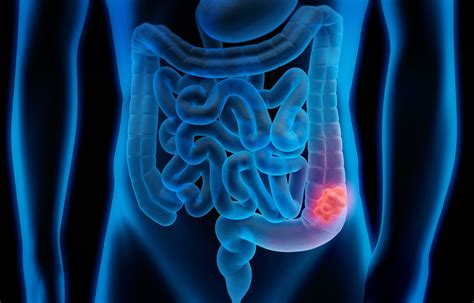 Stage 3 Colon Cancer: Symptoms, Diagnosis, and Treatment