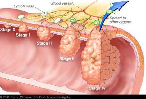 Stage 4 Colon Cancer | Spooky2 Reviews