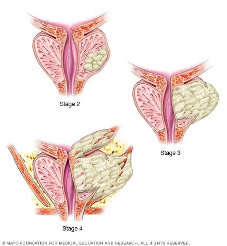 Stage 4 Prostate Cancer Prognosis   CancerWalls