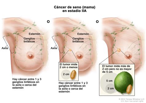 stage II breast cancer  Patient    Siteman Cancer Center