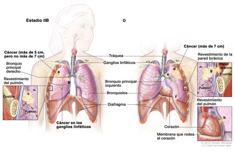 stage IIB non small cell lung cancer  Patient    Siteman ...