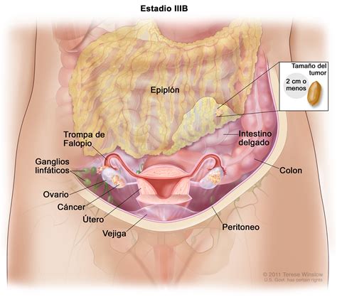stage III ovarian epithelial, fallopian tube, and primary ...