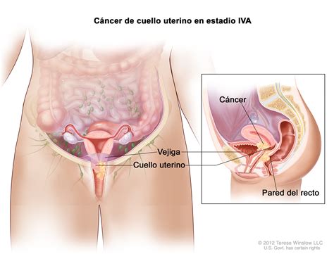stage IV cervical cancer  Patient    Siteman Cancer Center