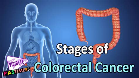 Stages of Colorectal Cancer || Health Tips   YouTube
