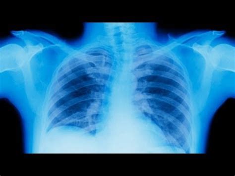 Stages of Lung Cancer   YouTube